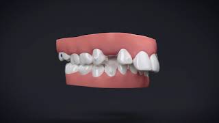 Invisalign® Treatment with Manidublar Advancement [upl. by Dearman518]