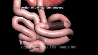 Intussusception Treatment video  Animaton by Cal Shipley MD [upl. by Adiazteb]