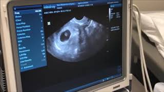 Pregnancy ultrasound at 6 weeks [upl. by Sabas]