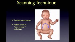 intussusception [upl. by Cr]