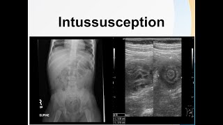 Intussusception [upl. by Lierbag]