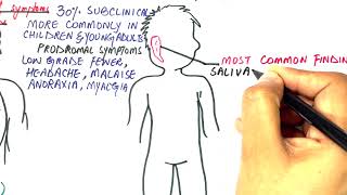 Mumps simple explanation [upl. by Yoral792]