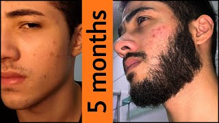 Minoxidil Beard Journey 5 MONTHS TRANSFORMATION [upl. by Swanson]