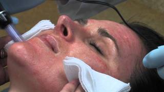 Dr Mark B Taylor Review of Dermapen Micro Needling  Gateway Aesthetics [upl. by Idihc]