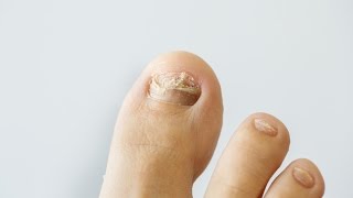 How to prevent and treat nail fungus [upl. by Othilia]