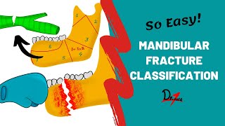 Mandibular Fracture Classification  DENTAL NOTES [upl. by Ennasil308]