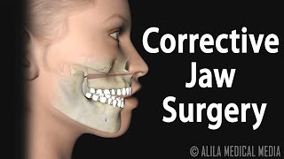 Corrective Jaw Orthognathic Surgery Animation [upl. by Ahsyek]