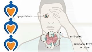 Schildklierproblemen  over de symptomen van hyperthyreoïdie hypothyreoïdie en struma [upl. by Oscar]