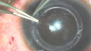 Intacs Insertion for Keratoconus [upl. by Atterys]