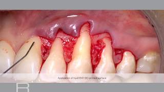 Treatment of gingival recession with a Coronally Advanced Flap by Prof Andrea Pilloni [upl. by Berti]