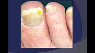 Toenail Debridement by a Podiatrist [upl. by Brie]