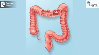 What is the treatment for Intussusception  Dr Nagaraj B Puttaswamy [upl. by Niassuh]