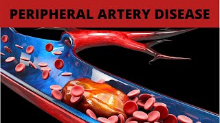 Treatment for Peripheral Artery Disease [upl. by Coppola]