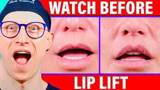 Lip Lift Healing Process [upl. by Bigelow]