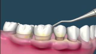 Raspado de encías  Periodoncia [upl. by Graeme]