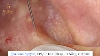 REMOVAL GOLD ACNE ON THE EAR 191  Loan Nguyen [upl. by Lubba588]