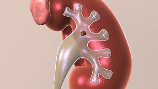 Preventing Kidney Stones  Urology Care Foundation [upl. by Chavaree]