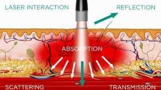 High Intensity Laser  Medical Effects [upl. by Annahael63]