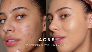 HOW TO COVER ACNE WITH MAKEUP BASE ROUTINE [upl. by Dagley]