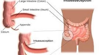 Intussusception [upl. by Shuman]