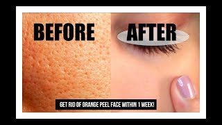 How to get rid of Orange peel Skin [upl. by Nnaear]