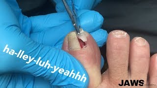 REMOVING A LARGE INGROWN TOENAIL [upl. by Ttelracs]