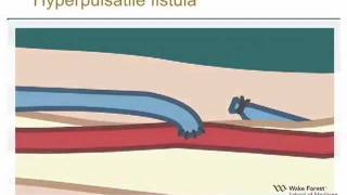 10minute Rounds Outflow Stenosis and the Arteriovenous Fistula [upl. by Gayler]