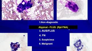 Thyroid Cytology I Approach [upl. by Mcquillin]