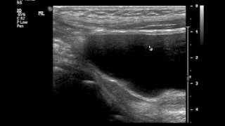 Intussusception US and Reductionmp4 [upl. by Ahsap37]