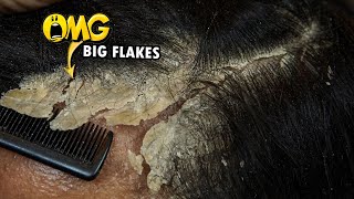 Dandruff Removal Big Flakes Satisfying 811 [upl. by Grenier]