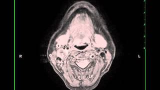 Glomus Vagale Paraganglioma right [upl. by Nereil]