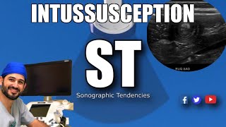 Intussusception Ultrasound [upl. by Duhl]