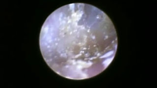 Dust Mites In Human Ears Feed On Skin [upl. by Wayland]