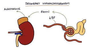 Hyperaldosteronism and Conns Syndrome [upl. by Lebazi]