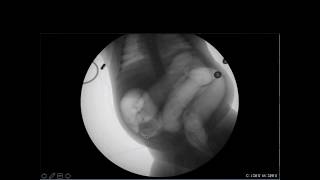 Pediatric Emergency POCUS Targeting Intussusception [upl. by Olegnaed444]