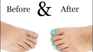 Toenail Treatment  Miracle Gelous Reconstruction [upl. by Eri]