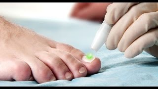 Toenail Fungus Onychomycosis treatment using the FOX Laser [upl. by Hibbitts]