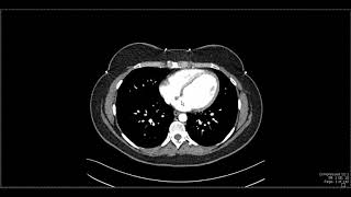 Ct Abdominal Angio Aortic Angiography [upl. by Itsyrc]