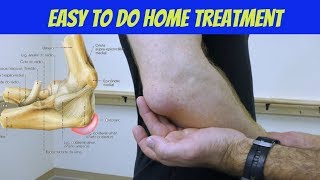 Elbow Bursitis Treatment at Home  How to Treat Olecranon Bursitis [upl. by Pomeroy]