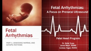 FETAL ARRHYTHMIAS Part One  Assessing Normal and Ectopic Rhythms [upl. by Aikal]