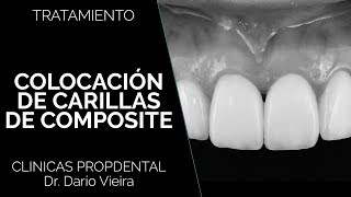 Carillas de composite en Propdental [upl. by Terr]