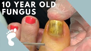 Fungus Takes Over Toenail  Toenail Removal [upl. by Osei]