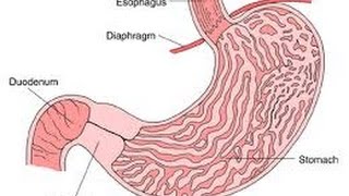 Pyloric Stenosis [upl. by Decato]