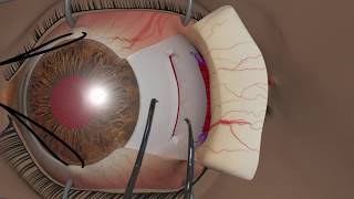 COVERTEST Binocular Vision Testing [upl. by Vetter]