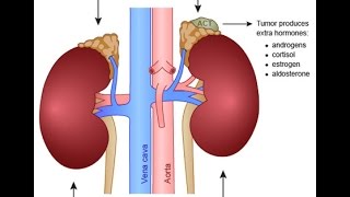 Primary Aldosteronism [upl. by Arezzini]