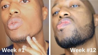 Minoxidil Beard Journey 3 Month Transformation [upl. by Ylluz]