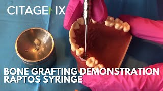 Basic Bone Grafting Procedure Demonstration With Raptos Syringe Citagenix Products  Citagenix [upl. by Jardena330]