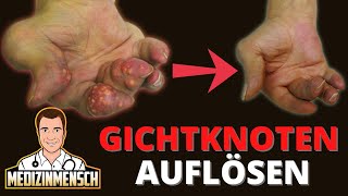 GICHTKNOTEN auflösen GICHTARZT erklärt wie es geht — ohne Chirurgie [upl. by Deva822]