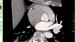 Coronary CT Angiography Anomalous RCA [upl. by Ahseined]