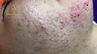 Blackheads Removal 333a  Loan Nguyen [upl. by Rhee]